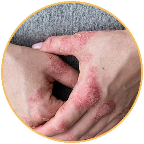 Dermatitis