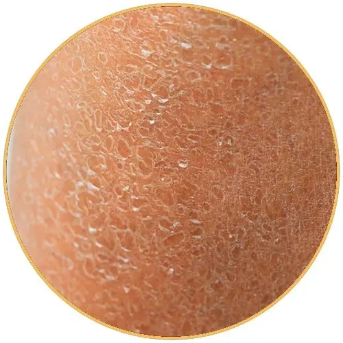 Ichtyosis