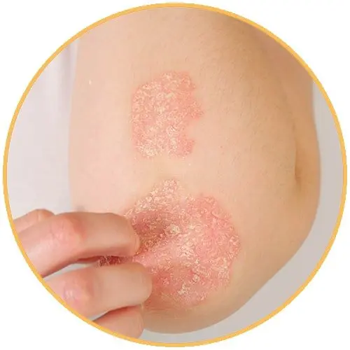 Psoriasis