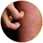 Flaky Skin